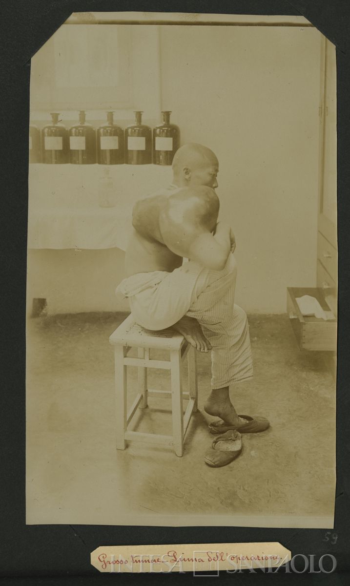 Istituto Canossiano italiano a Han-Kow (Cina), ospedale: paziente con grosso tumore  prima dell'operazione, 1900 (fotografo sconosciuto)